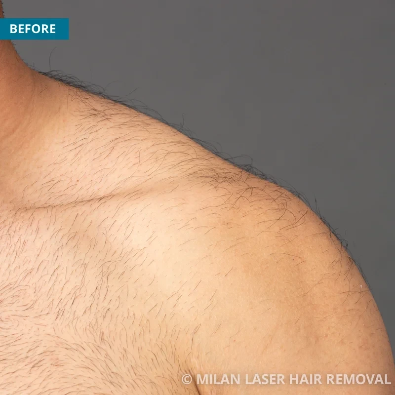 How Long Will it Take to Remove Upper Lip Hair with Laser Therapy?: Laser  Bar & Spa: Laser Hair Removal