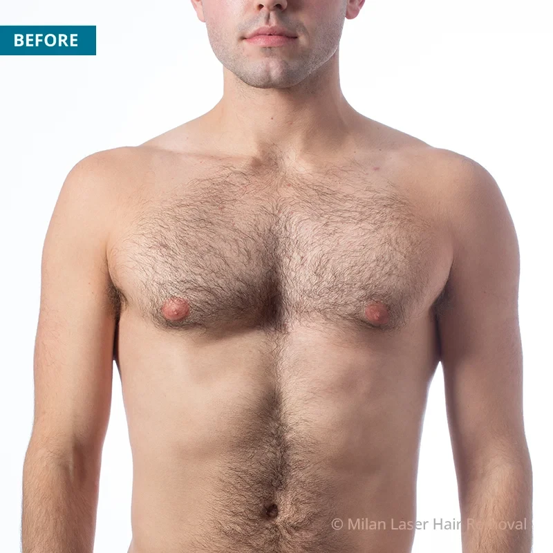 Men's Before & After Photos of Laser Hair Removal | Milan Laser in  Philadelphia, PA