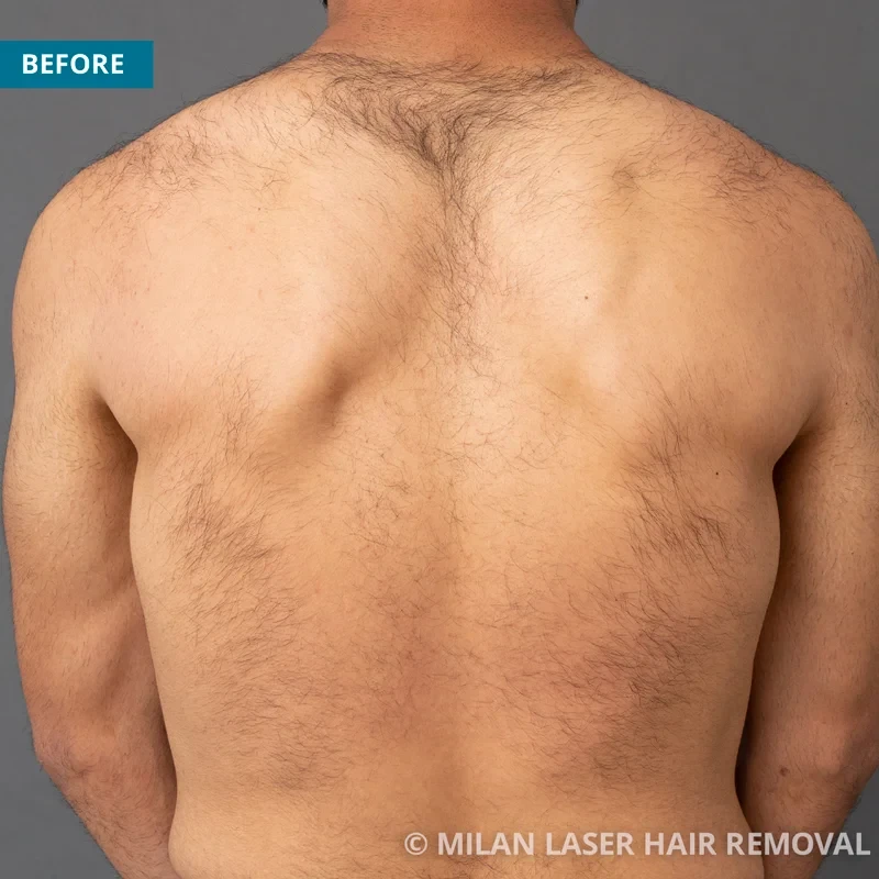 Men's Before & After Photos of Laser Hair Removal | Milan Laser in  Philadelphia, PA