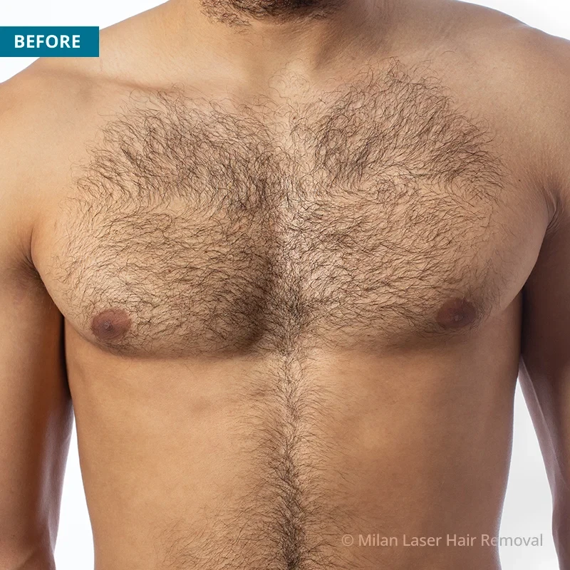 Electrolysis permanent body hair removal for men | Peach Clinics